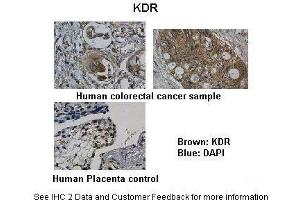 Researcher: Department of Pathology, Hospital de Carabineros de Chile, Santiago, ChileApplication: IHCSpecies+tissue/cell type: Control-Human Placenta, Sample-Human colorectal cancer Primary Antibody dilution: 1:100Secondary Antibody: Biotinylated pig anti-rabbit+streptavidin-HRP (VEGFR2/CD309 Antikörper  (N-Term))