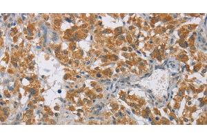 Immunohistochemistry of paraffin-embedded Human thyroid cancer tissue using DIO1 Polyclonal Antibody at dilution 1:60 (DIO1 Antikörper)