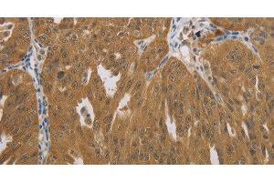 Immunohistochemistry of paraffin-embedded Human ovarian cancer using NIT2 Polyclonal Antibody at dilution of 1:40 (NIT2 Antikörper)