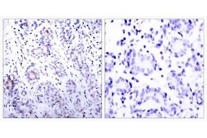 Immunohistochemical analysis of paraffin-embedded human breast carcinoma tissue using STAT3 (Ab-727) antibody (E021046). (STAT3 Antikörper)
