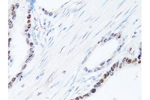 Immunohistochemistry of paraffin-embedded human colon carcinoma using SQSTM1 antibody. (SQSTM1 Antikörper  (AA 1-440))