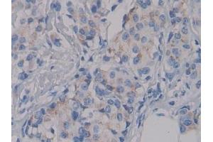Detection of NPHN in Human Breast cancer Tissue using Polyclonal Antibody to Nephrin (NPHN) (Nephrin Antikörper  (AA 23-92))