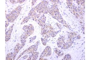 IHC-P Image PIGK antibody [N1C2] detects PIGK protein at cytosol on human breast carcinoma by immunohistochemical analysis. (PIGK Antikörper)
