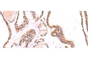 Immunohistochemistry of paraffin-embedded Human thyroid cancer tissue using TOR1AIP1 Polyclonal Antibody at dilution of 1:70(x200) (TOR1AIP1 Antikörper)