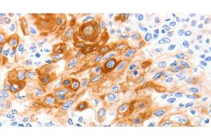 Immunohistochemistry of paraffin-embedded Human cervical cancer tissue using SLC2A11 Polyclonal Antibody at dilution 1:140 (SLC2A11 Antikörper)