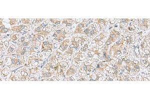 Immunohistochemistry of paraffin-embedded Human liver cancer tissue using NDRG4 Polyclonal Antibody at dilution of 1:45(x200) (NDRG4 Antikörper)