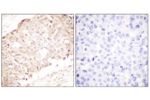 Immunohistochemistry analysis of paraffin-embedded human breast carcinoma tissue using SENP1 antibody. (SENP1 Antikörper  (N-Term))