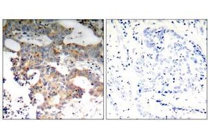 Immunohistochemical analysis of paraffin-embedded human breast carcinoma tissue using IkB-ε (Ab-22) antibody (E021296). (NFKBIE Antikörper)