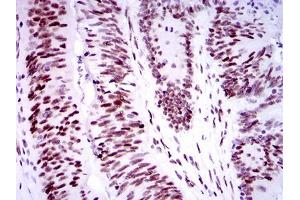 Immunohistochemical analysis of paraffin-embedded colon cancer tissues using TP53BP1 mouse mAb with DAB staining. (TP53BP1 Antikörper  (AA 574-773))
