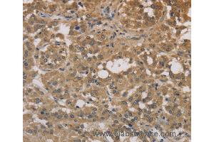Immunohistochemistry of Human liver cancer using DEGS1 Polyclonal Antibody at dilution of 1:30