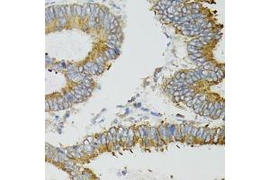 Immunohistochemistry of paraffin-embedded human colon carcinoma using ND5 antibody (ABIN5975833) at dilution of 1/100 (40x lens).