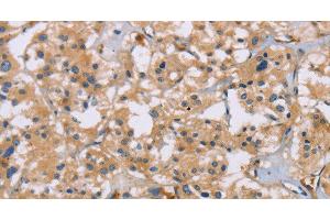 Immunohistochemistry of paraffin-embedded Human thyroid cancer using ACTN4 Polyclonal Antibody at dilution of 1:60 (alpha Actinin 4 Antikörper)