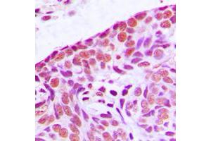 Immunohistochemical analysis of MEKK3 staining in human breast cancer formalin fixed paraffin embedded tissue section.