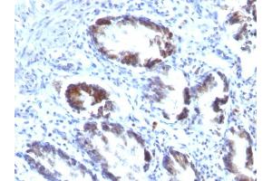 Formalin-fixed, paraffin-embedded human Colon Carcinoma stained with Transgelin Monoclonal Antibody (TAGLN/247) (Transgelin Antikörper)