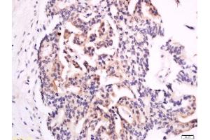 Formalin-fixed and paraffin embedded human colon carcinoma labeled with Anti-XTP4 Polyclonal Antibody, Unconjugated  at 1:300 followed by conjugation to the secondary antibody and DAB staining. (C17orf37 Antikörper  (AA 10-60))