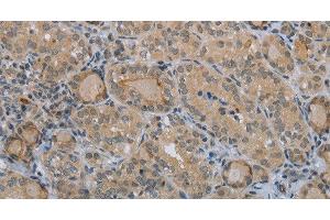 Immunohistochemistry of paraffin-embedded Human thyroid cancer tissue using CLEC1A Polyclonal Antibody at dilution 1:40