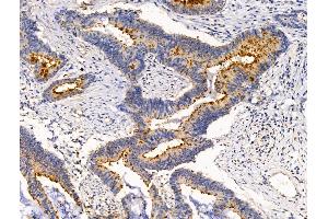 ABIN7094654 and ABIN7098705 at 1/100 staining Human colorectal cancer by IHC-P.