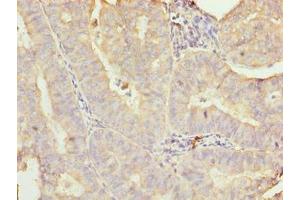 Immunohistochemistry of paraffin-embedded human endometrial cancer using ABIN7160680 at dilution of 1:100 (GALNT7 Antikörper  (AA 201-500))