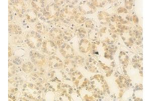 ABIN6262024 and ABIN6279478 at 1/100 staining human renal cell carcinoma by IHC-P.