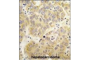 Formalin-fixed and paraffin-embedded human hepatocarcinoma tissue reacted with the VARS antibody (N-term)  , which was peroxidase-conjugated to the secondary antibody, followed by DAB staining. (VARS Antikörper  (N-Term))