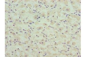 Immunohistochemistry of paraffin-embedded human gastric cancer using ABIN7146581 at dilution of 1:100 (Calsequestrin Antikörper  (AA 127-396))