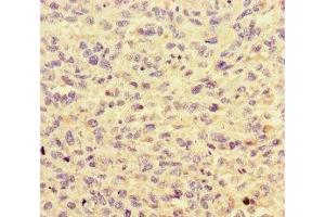 Immunohistochemistry of paraffin-embedded human melanoma using ABIN7155108 at dilution of 1:100 (HNRNPF Antikörper  (AA 186-336))