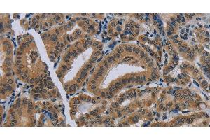 Immunohistochemistry of paraffin-embedded Human thyroid cancer using NAT10 Polyclonal Antibody at dilution of 1:40