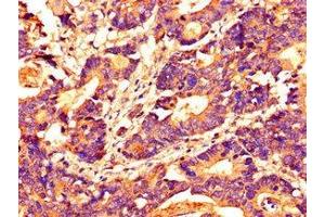 Immunohistochemistry of paraffin-embedded human colon cancer using ABIN7155305 at dilution of 1:100