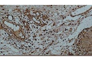 Immunohistochemistry of paraffin-embedded Human colon using Galectin 3 Monoclonal Antibody at dilution of 1:50. (Galectin 3 Antikörper)