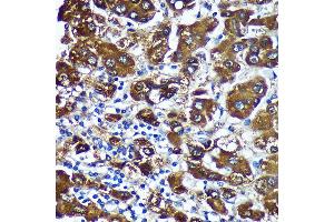 Immunohistochemistry of paraffin-embedded Human liver cancer using CTNN Rabbit pAb (ABIN7266136) at dilution of 1:100 (40x lens). (CTNNA3 Antikörper  (AA 1-240))