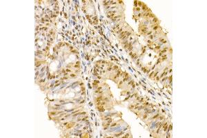 Immunohistochemistry of paraffin-embedded human colon carcinoma using SS18 Rabbit pAb (ABIN6133185, ABIN6148473, ABIN6148474 and ABIN6222754) at dilution of 1:100 (40x lens). (SS18 Antikörper  (AA 1-240))