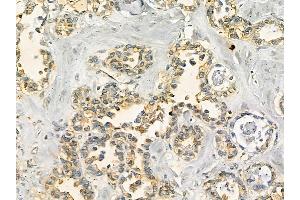 MLKL Mouse Monoclonal Antibody at 1/100 staining human ovarian cancer by IHC-P.