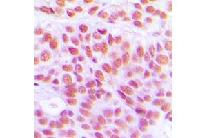 Immunohistochemical analysis of Histone H4 (AcK12) staining in human breast cancer formalin fixed paraffin embedded tissue section. (Histone H4 Antikörper  (acLys12, N-Term))