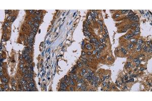 Immunohistochemistry of paraffin-embedded Human colon cancer tissue using CLDND1 Polyclonal Antibody at dilution 1:40 (CLDND1 Antikörper)