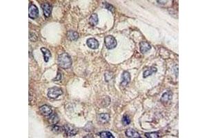 IHC analysis of FFPE human hepatocarcinoma tissue stained with AFP antibody (alpha Fetoprotein Antikörper  (AA 300-329))