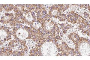 ABIN6279253 at 1/100 staining Human liver cancer tissue by IHC-P. (CPD Antikörper  (N-Term))