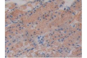 IHC-P analysis of Mouse Stomach Cancer Tissue, with DAB staining. (SLIT1 Antikörper  (AA 603-773))