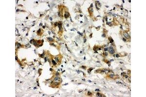 IHC-P: COMT antibody testing of human lung cancer tissue