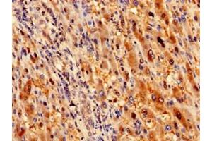 Immunohistochemistry analysis of human liver cancer using ABIN7168095 at dilution of 1:100 (Ribokinase Antikörper  (AA 2-322))