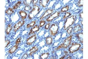 Formalin-fixed, paraffin-embedded human Renal Cell Carcinoma stained with Interferon gamma Mouse Monoclonal Antibody (IFNG/466). (Interferon gamma Antikörper)
