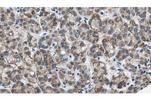 ABIN6269004 at 1/100 staining Human liver cancer tissue by IHC-P. (Metabotropic Glutamate Receptor 3 Antikörper  (C-Term))