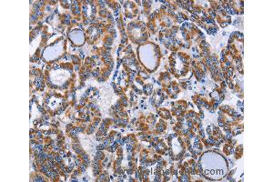 Immunohistochemistry of Human lung cancer using INTS10 Polyclonal Antibody at dilution of 1:50 (INTS10 Antikörper)