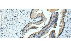Immunohistochemistry of paraffin-embedded Human prost ate cancer tissue using FCRLA Polyclonal Antibody at dilution of 1:90(x200) (FCRLA Antikörper)