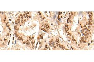 Immunohistochemistry of paraffin-embedded Human liver cancer tissue using URI1 Polyclonal Antibody at dilution of 1:45(x200)