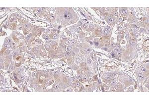 ABIN6272716 at 1/100 staining Human liver cancer tissue by IHC-P. (OR1K1 Antikörper)