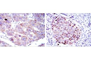 Immunohistochemical analysis of paraffin-embedded liver cancer tissues (left) and kidney cancer tissues (right) using EEF2 mouse mAb with DAB staining. (EEF2 Antikörper)