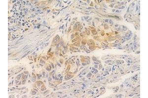 ABIN6261413 and ABIN6266532 at 1/100 staining human lung squamous cell carcinoma by IHC-P. (E2F6 Antikörper  (Internal Region))