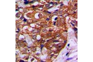 Immunohistochemical analysis of MVK staining in human breast cancer formalin fixed paraffin embedded tissue section.