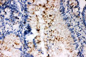 Anti-SSX2 antibody, IHC(P) IHC(P): Human Intestinal Cancer Tissue