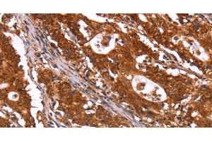 Immunohistochemistry of paraffin-embedded Human gastric cancer using ABI1 Polyclonal Antibody at dilution of 1:40 (ABI1 Antikörper)